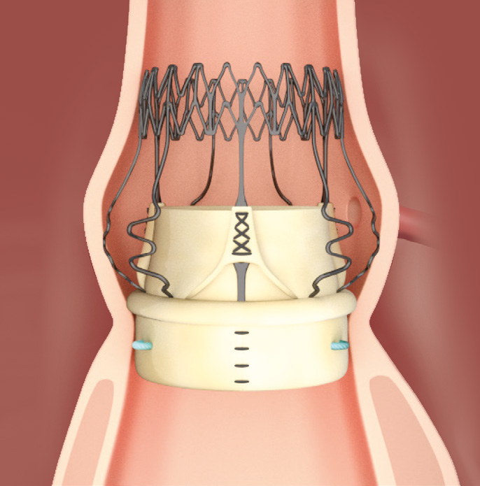 Cardiac Surgery Medical Devices & Consumables